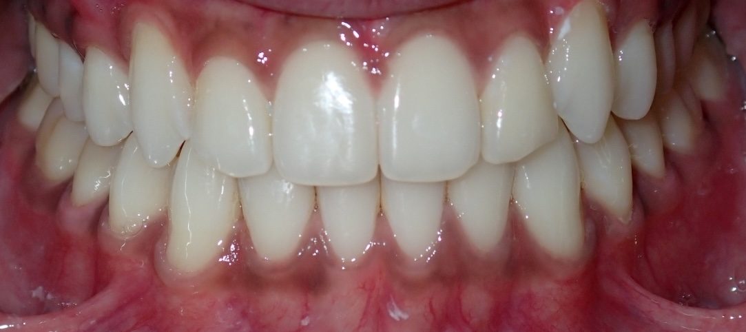 Vivid Smiles patient case 5 before and after treatment comparison after